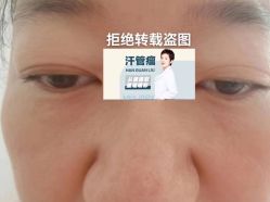 -爱莎扁平疣·汗管瘤·斑痣中心