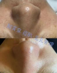 -靓芙泉·0感专研祛痘