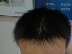 -碧莲盛·不剃发植发