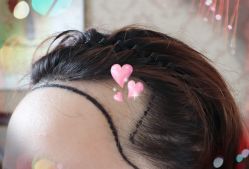 -大麦微针植发全国连锁