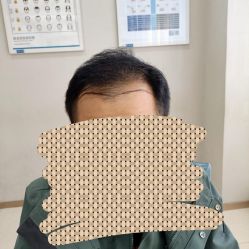 体验后-大麦微针植发丨全国连锁