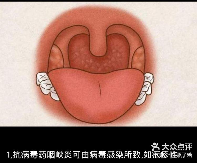 咽喉疱疹图片图片