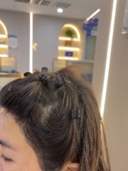 -碧莲盛不剃发植发
