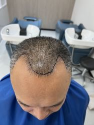 体验前-大麦微针植发全国连锁