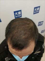 -大麦微针植发丨全国连锁
