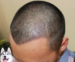 -大麦微针植发丨全国连锁