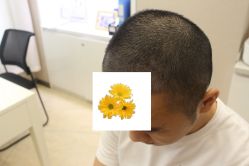 -大麦微针植发丨全国连锁