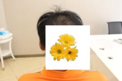-大麦微针植发丨全国连锁