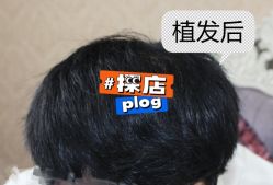 -大麦微针植发全国连锁