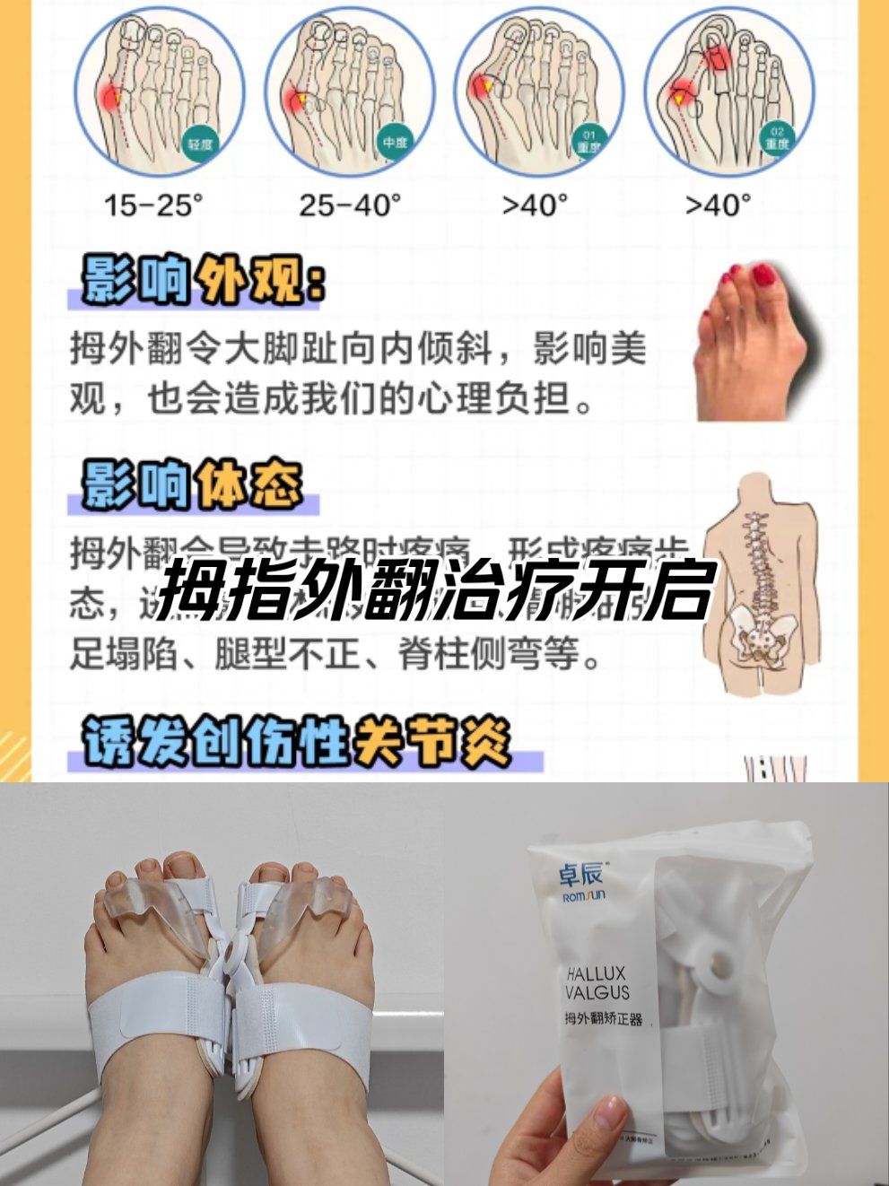 拇指外翻不要忽视