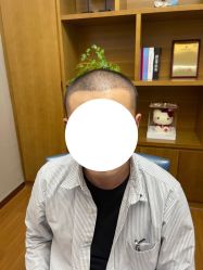 -大麦微针植发全国连锁