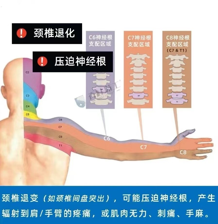 手麻可能是神经根型颈椎病