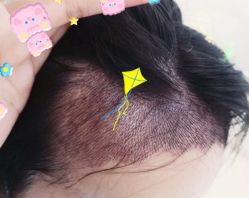 -大麦微针植发全国连锁