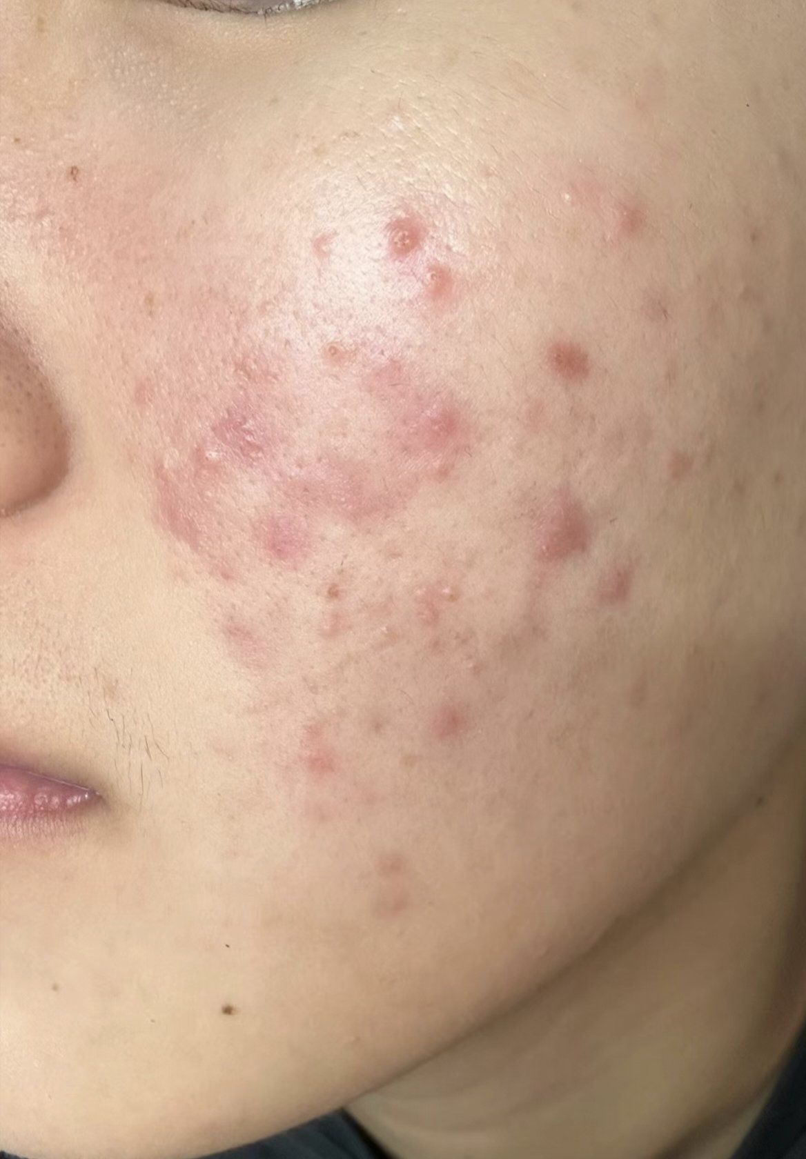 痘印会随着时间自己消失吗红色痘印儿啊