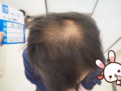 -大麦微针植发丨全国连锁