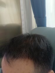 -碧莲盛·不剃发植发