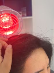 -大麦微针植发全国连锁