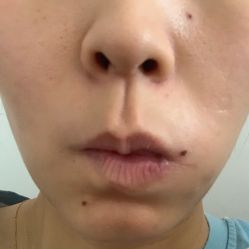 体验后-CMS西美斯·美式医疗美容