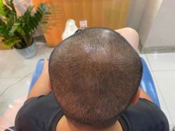 -大麦微针植发全国连锁