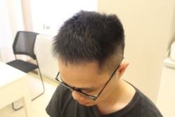 点击看大图 -大麦微针植发丨全国连锁