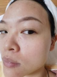 体验后-南昌艾莱芙美容医院