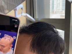 -碧莲盛·不剃发植发