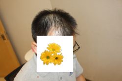 -大麦微针植发丨全国连锁