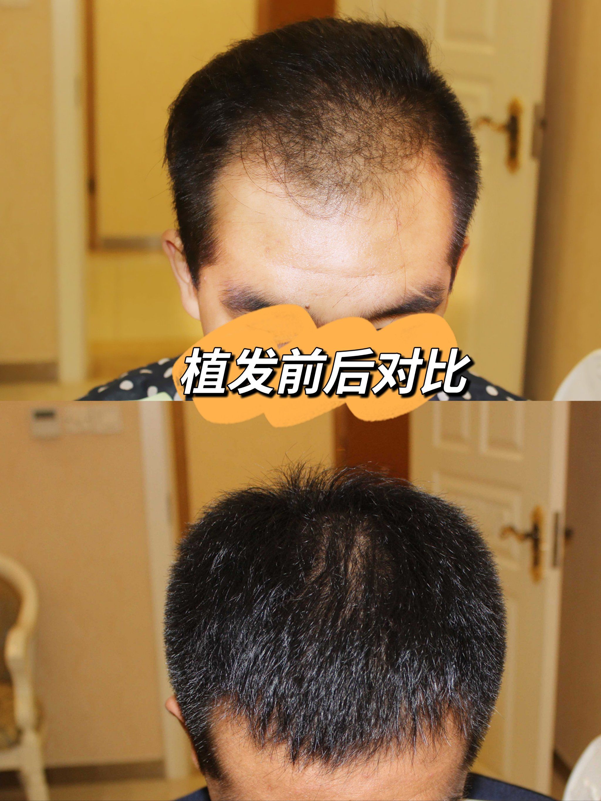 植发不要犹豫哦