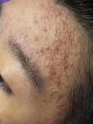 -苗方清颜专业祛痘连锁机构