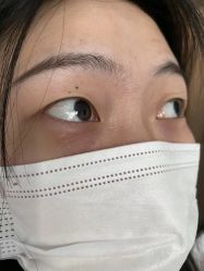 -爱莎扁平疣·汗管瘤·斑痣中心