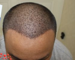 -大麦微针植发丨全国连锁