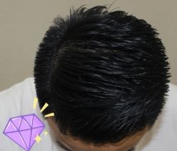 -大麦微针植发丨全国连锁