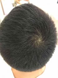 点击看大图 -大麦微针植发全国连锁