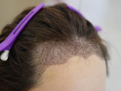 -大麦微针植发丨全国连锁