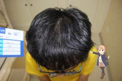 -大麦微针植发丨全国连锁