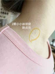 体验后-清疣美疣·痣·斑净肤中心