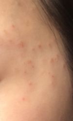 -爱莎扁平疣·汗管瘤·斑痣中心