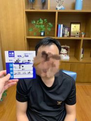 体验前-大麦微针植发全国连锁