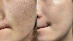 -成都苗方清颜专业祛痘