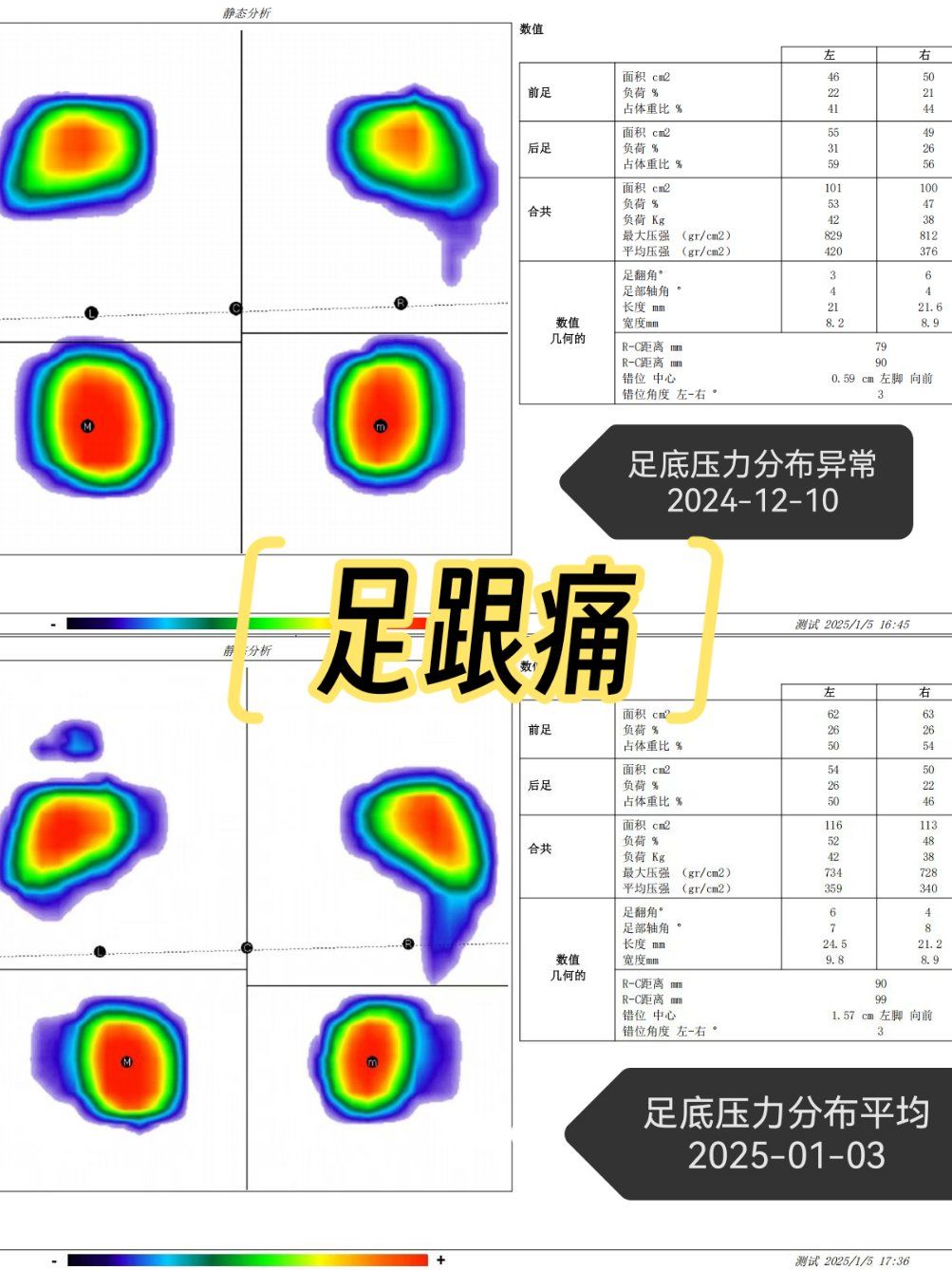 🌟【足底压力分析仪:揭秘疼痛背后的真相!】