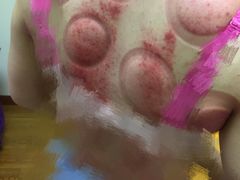 拔罐-沈师傅盲人按摩工作室(密三小区店)