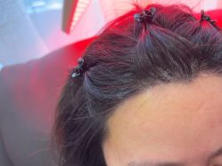 -碧莲盛·不剃发植发