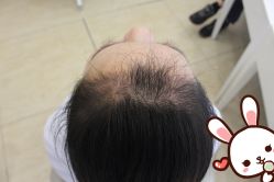 点击看大图 -大麦微针植发丨全国连锁