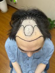 -大麦微针植发全国连锁