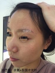 水光针-光SPA科技美肤