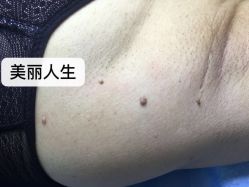 -爱莎扁平疣·汗管瘤·斑痣中心