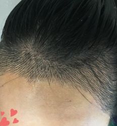 -大麦微针植发丨全国连锁