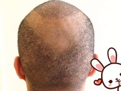 点击看大图 -大麦微针植发丨全国连锁