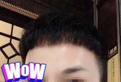 -大麦微针植发丨全国连锁