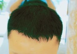 -大麦微针植发丨全国连锁